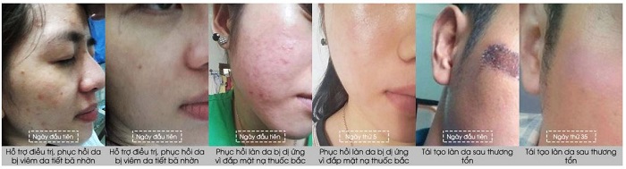 Hiệu quả của khách hàng sau khi sử dụng kem mật ong Manuka 16+ Madeleine Ritchie