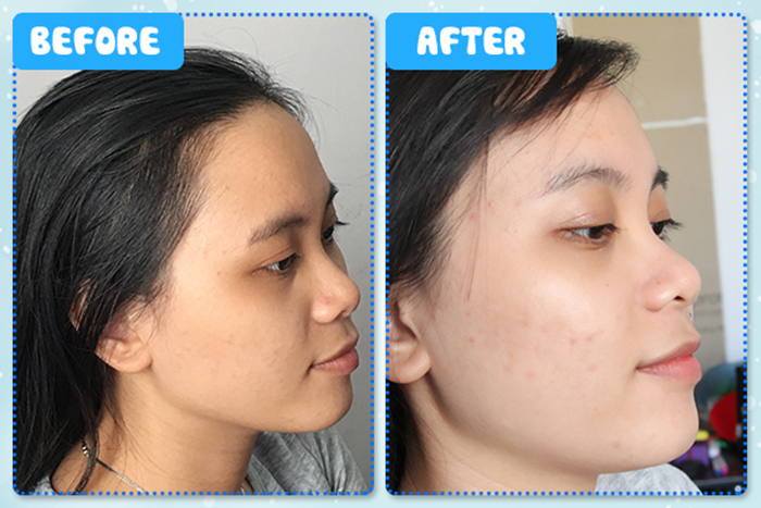 Chỉ sau 4 tuần sử dụng, làn da của bạn Ngọc Đàm đã có sự cải thiện rõ rệt 