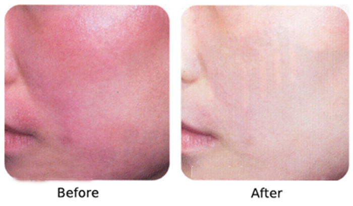 Sữa rửa mặt Sakura giúp cho làn da kích ứng được hồi phục và trở lại trạng thái bình thường Sữa rửa mặt Sakura giúp cho làn da bị kích ứng được hồi phục và trở lại trạng thái bình thường