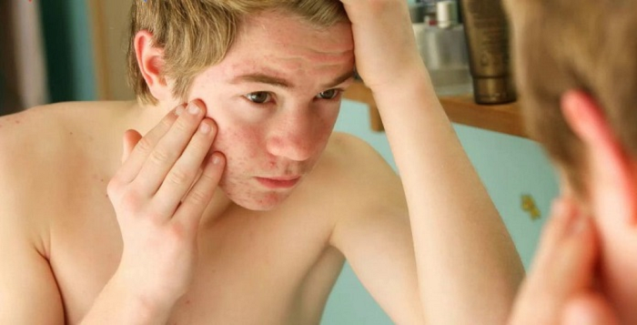 Bã nhờn là nguyên nhân lớn nhất gây mụn ở nam giới