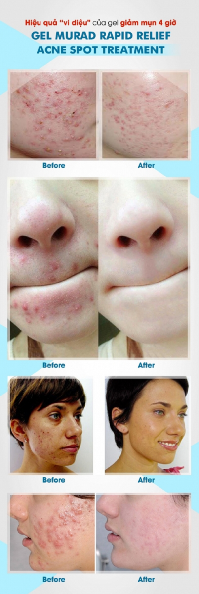 Hiệu quả sau khi sử dụng gel giảm mụn trong 4 giờ Murad Rapid Relief Acne Spot Treatment