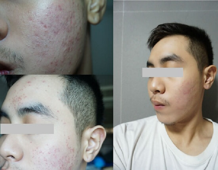 Hiệu quả giảm mụn rõ rệt của khách hàng sau khi sử dụng kem hỗ trợ giảm mụn Sakura Acne Clearing Cream