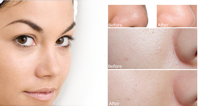 Khám phá cách làm se khít lỗ chân lông trên mặt hiệu quả nhất